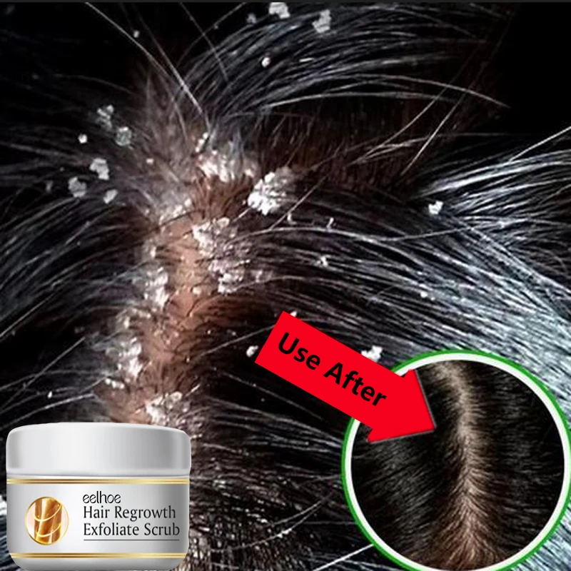 Fast Anti Dandruff Hair Treatm - đánh giá và giá Scalp Scrub Exfoliant