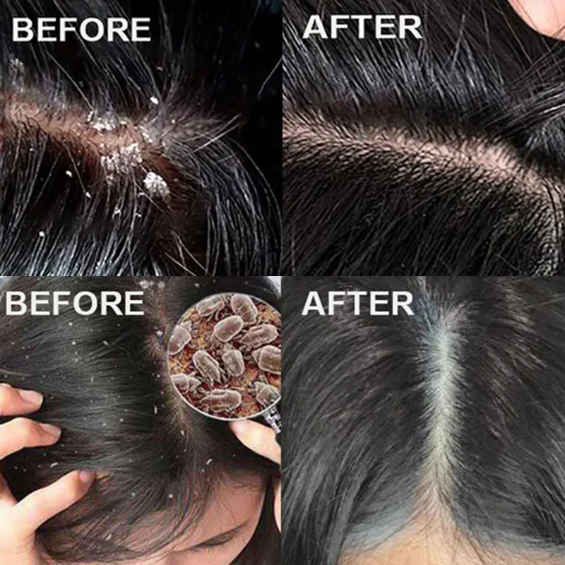 Fast Anti Dandruff Hair Treatm - đánh giá và giá Scalp Scrub Exfoliant